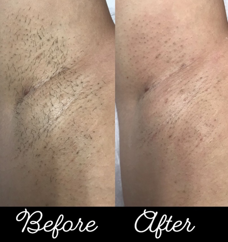 Before and after — underarm waxing